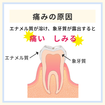 歯が痛くなる原因を表した歯のイラスト