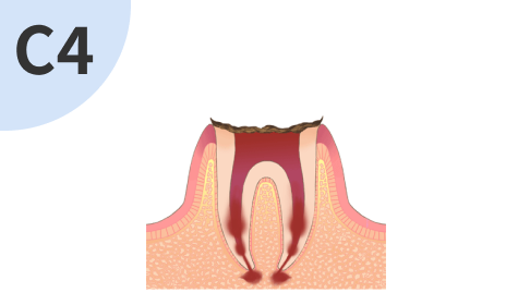歯の根元、骨まで進行した虫歯