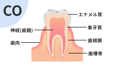 ごく初期段階の虫歯